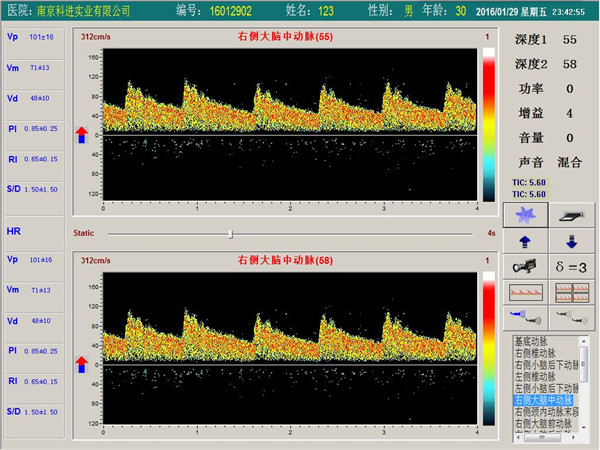經(jīng)顱多普勒單通道，雙深度界面