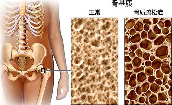 骨質健康問題.jpg