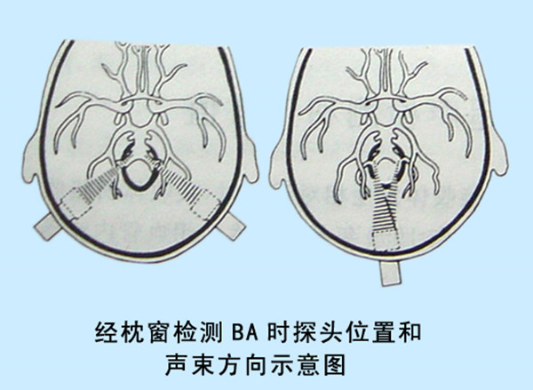 04經枕窗檢測BA時探頭位置和聲束方向示意圖.jpg