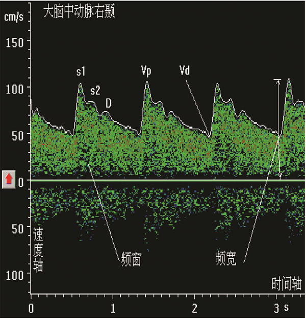 經(jīng)顱多普勒正常的頻譜圖像.jpg