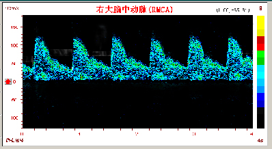 超聲經(jīng)顱多普勒腦動脈硬化頻譜圖.jpg