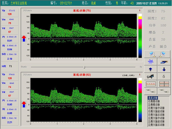 超聲經(jīng)顱多普勒血流分析儀雙窗口（雙通道或雙深度）檢測(cè)界面.jpg