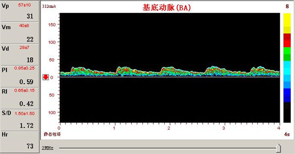 椎一基底動脈供血不足.jpg