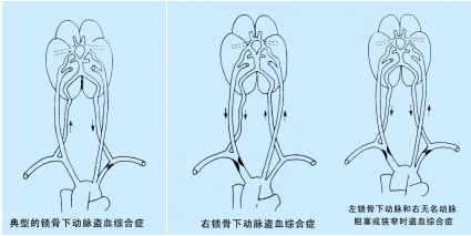 鎖骨下動脈盜血綜合征超聲TCD表現(xiàn)