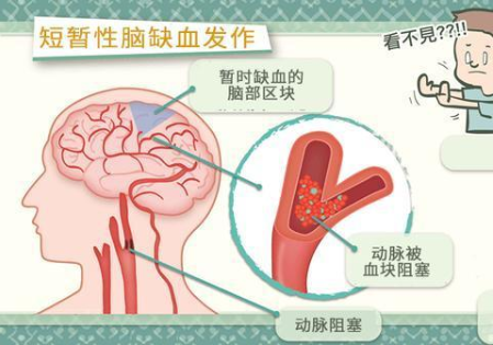 短暫性腦缺血是什么 經(jīng)顱多普勒可確診