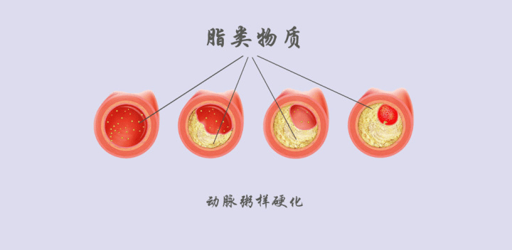 腦動脈粥樣硬化是什么意思 怎么形成的