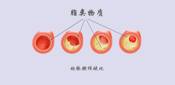 顱內(nèi)動(dòng)脈粥樣硬化與缺血性腦卒中的關(guān)系