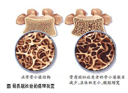 正常與骨質(zhì)健康問題骨密度對(duì)比